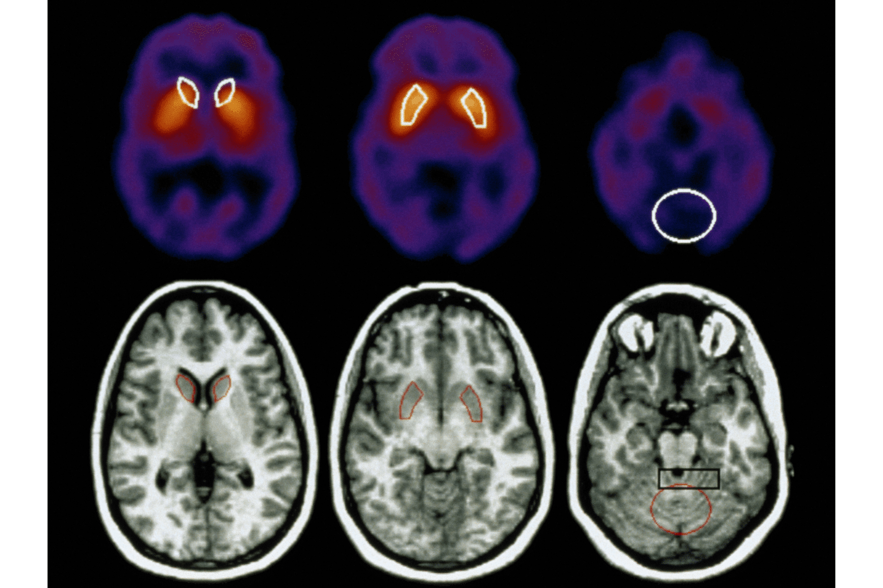 connecting-every-neuron-the-future-of-brain-mapping-and-illness